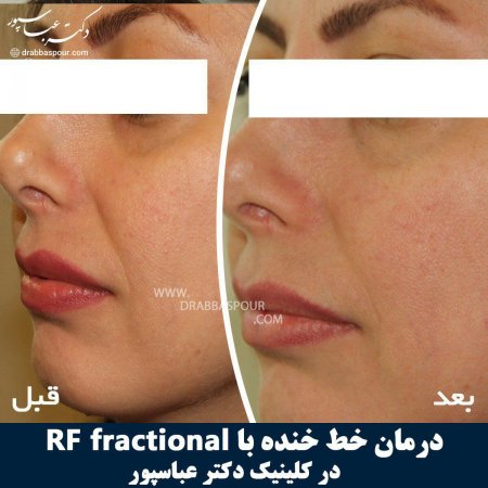 درمان خط خنده بدون تزریق ژل با دستگاه RF Fractional