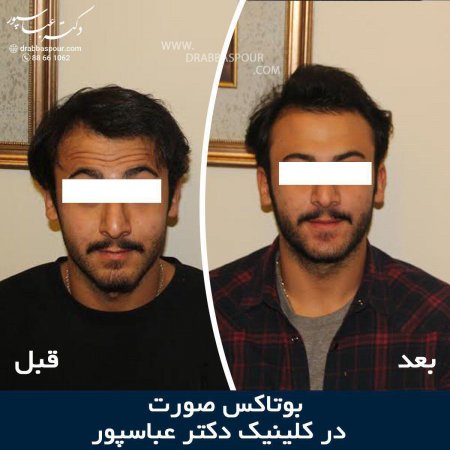 بوتاکس پیشانی